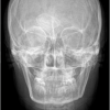 RX ANTEROPOSTERIOR y POSTEROANTERIOR