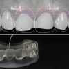 DISEÑO DE SONRISA Y LLAVE PARA CARILLAS INYECTADAS POR ARCADA