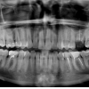 RX PANORAMICA (ORTOPANTOMOGRAFIA)